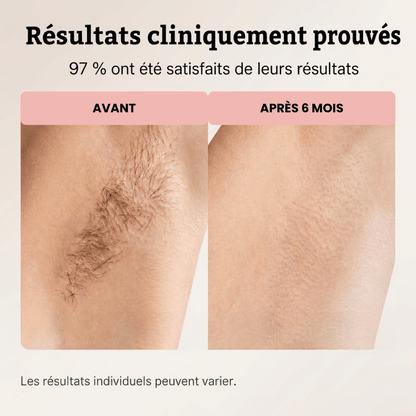 Moins de poils. Moins souvent. - Yunae Beauty CH