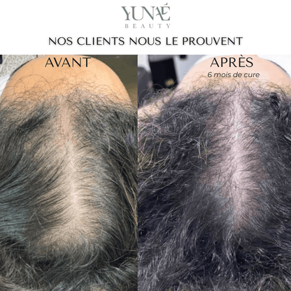 Shampoing Solide Anti - Chute — Élixir Concentré - Yunae Beauty CH